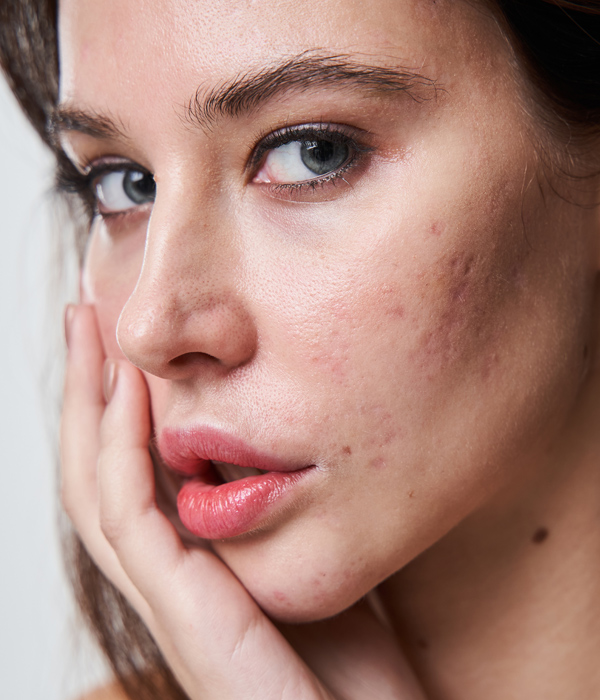 Skinboss - Acne Scarring
