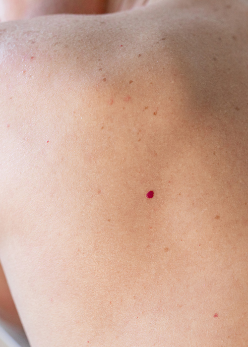 Skinboss - Cherry Angiomas