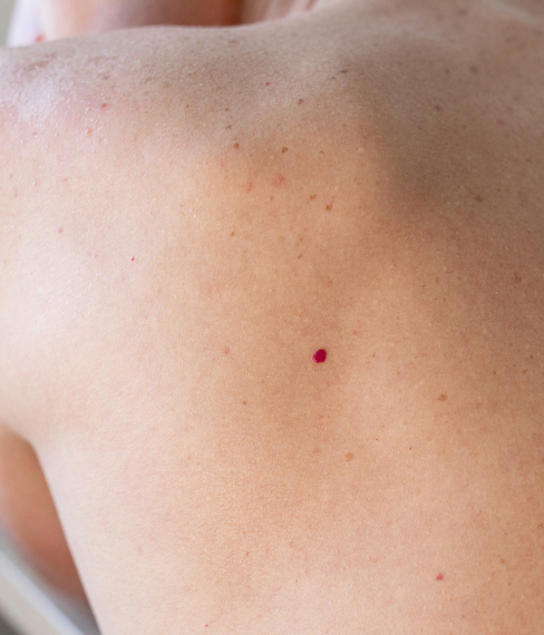 Skinboss - Cherry Angiomas
