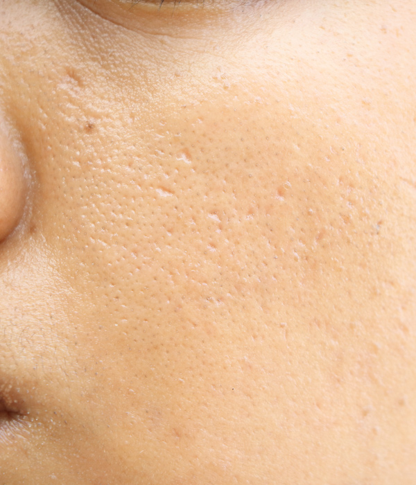 Skinboss - Enlarged Pores / Comedones