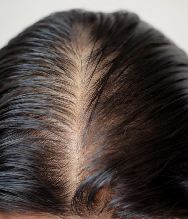 Skinboss - Hair Loss