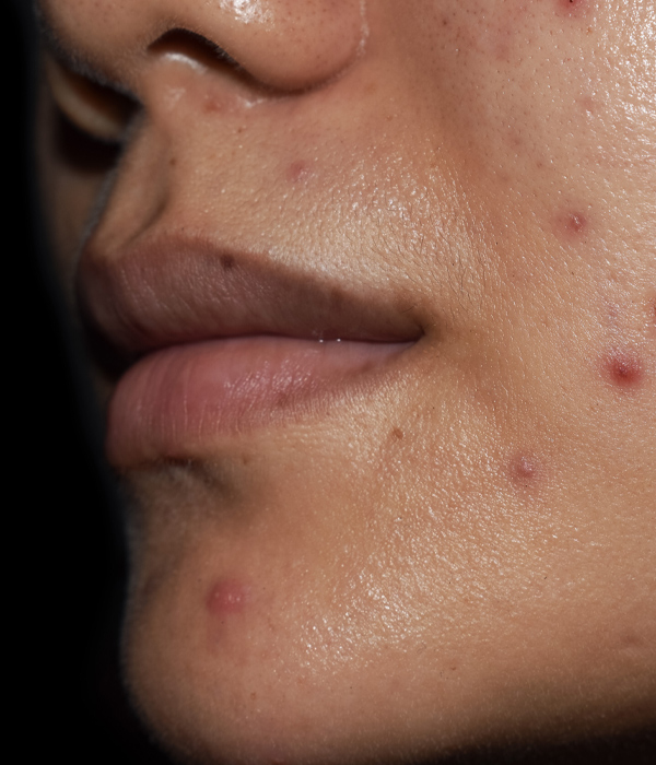 Skinboss - Post Inflammatory Scaring (PIH)