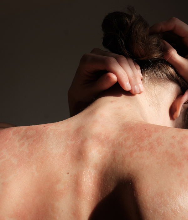 Skinboss - Psoriasis / Eczema