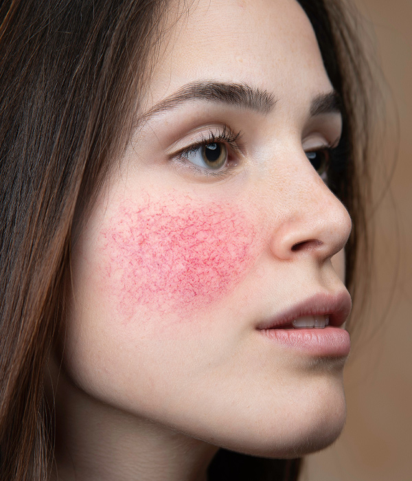 Skinboss - Rosacea