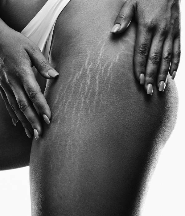 Skinboss - Stretch Marks