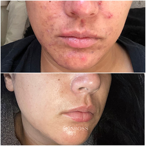 Skinboss - Acne - Before & After