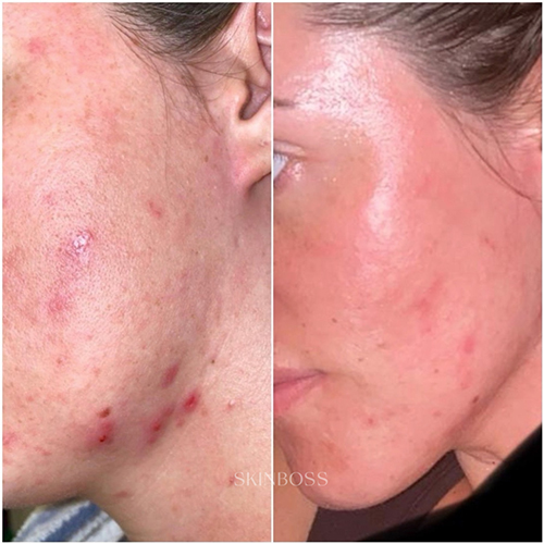 Skinboss - Acne - Before & After