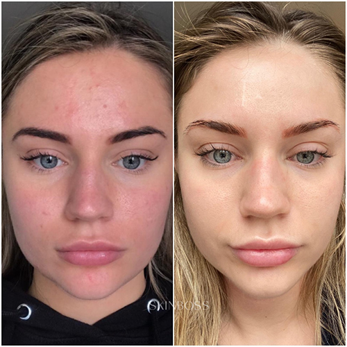 Skinboss - Acne - Before & After