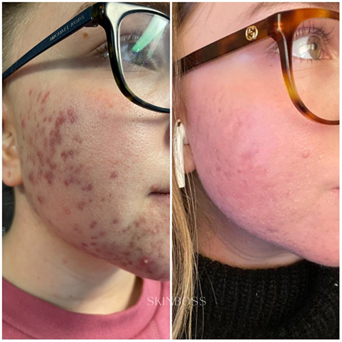 Skinboss - Acne - Before & After