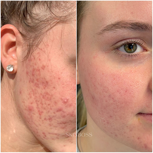 Skinboss - Acne - Before & After