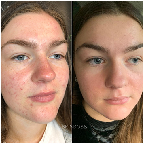 Skinboss - Acne - Before & After