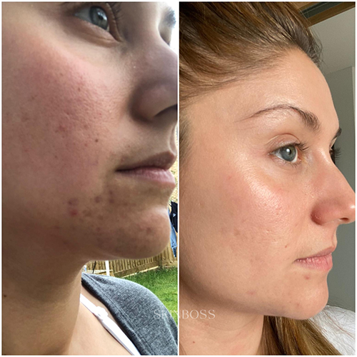 Skinboss - Acne - Before & After