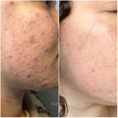 Skinboss - Acne - Before & After