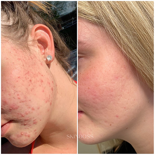 Skinboss - Acne - Before & After