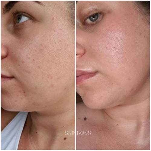 Skinboss - Acne - Before & After