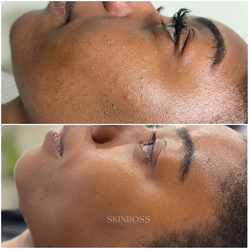 Skinboss - Acne - Before & After