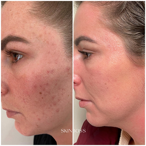 Skinboss - Acne - Before & After