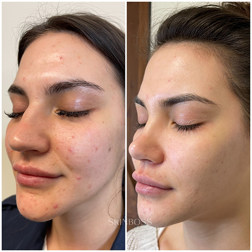 Skinboss - Acne - Before & After