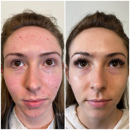 Skinboss - Acne - Before & After