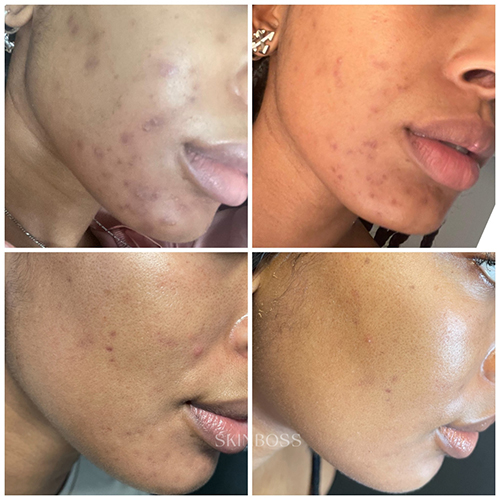 Skinboss - Acne - Before & After