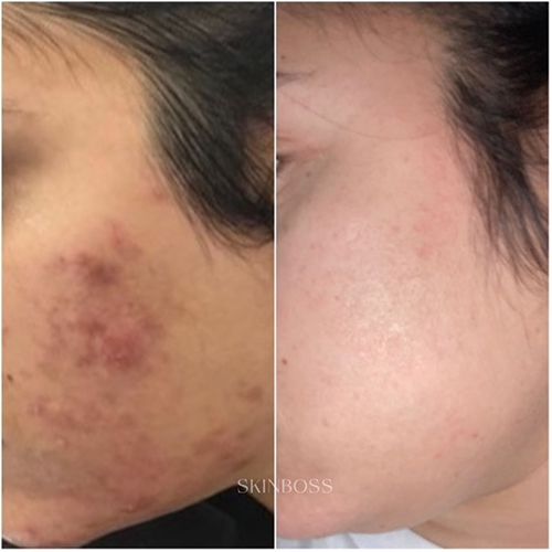 Skinboss - Acne - Before & After