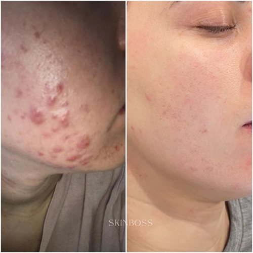 Skinboss - Acne - Before & After