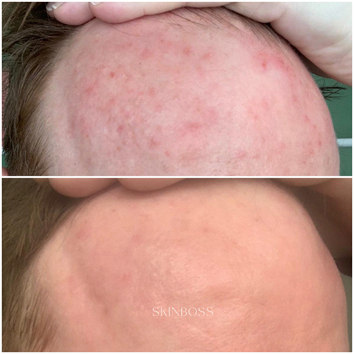 Skinboss - Acne - Before & After