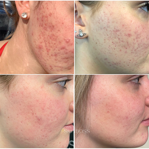 Skinboss - Acne - Before & After