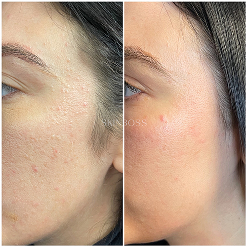 Skinboss - Acne - Before & After