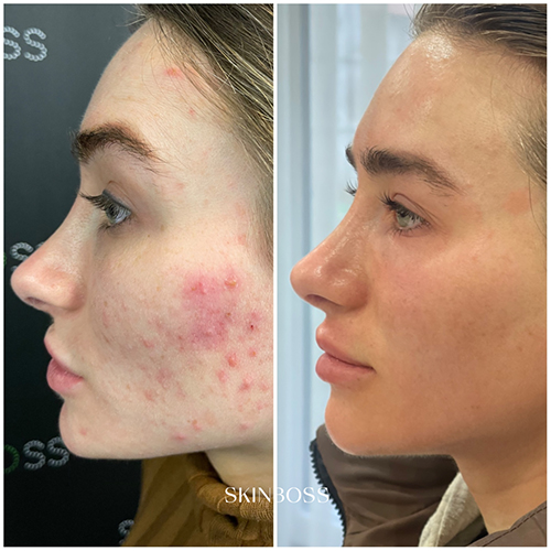 Skinboss - Acne - Before & After