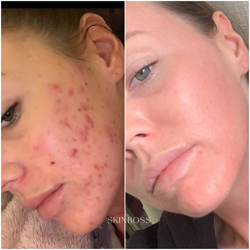 Skinboss - Acne - Before & After