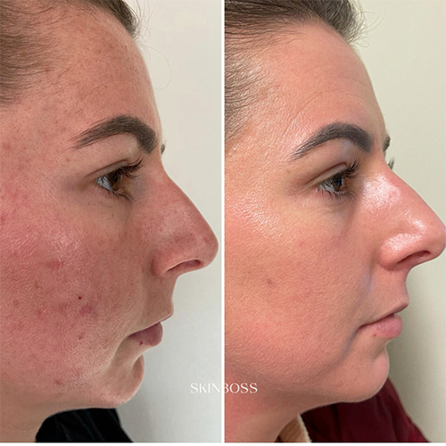 Skinboss - Acne - Before & After