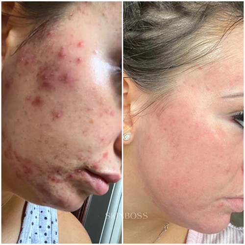 Skinboss - Acne - Before & After