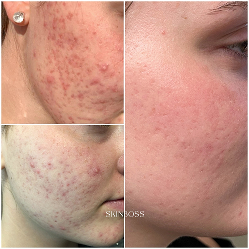 Skinboss - Acne - Before & After