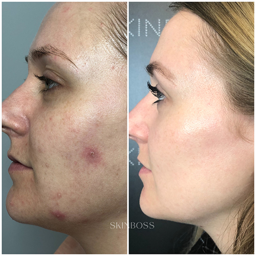 Skinboss - Acne - Before & After