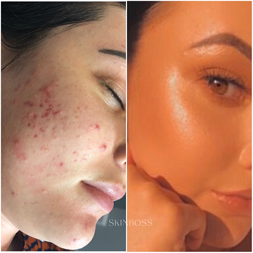 Skinboss - Acne - Before & After