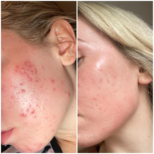 Skinboss - Acne - Before & After