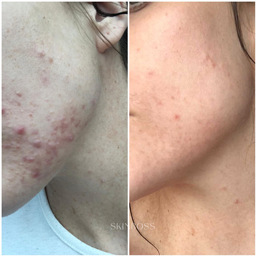 Skinboss - Acne - Before & After