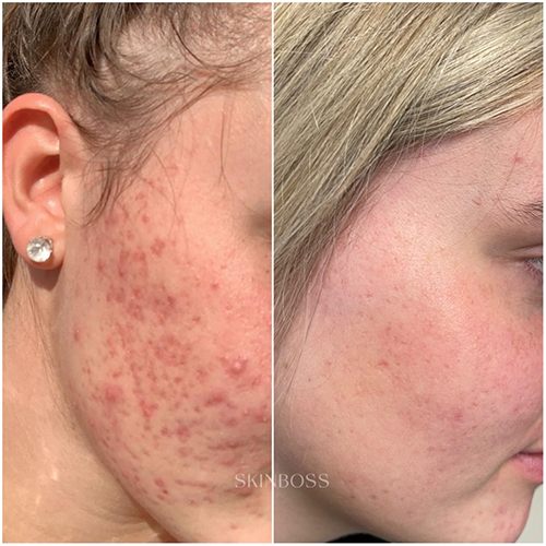 Skinboss - Acne Scaring & PIH - Before & After