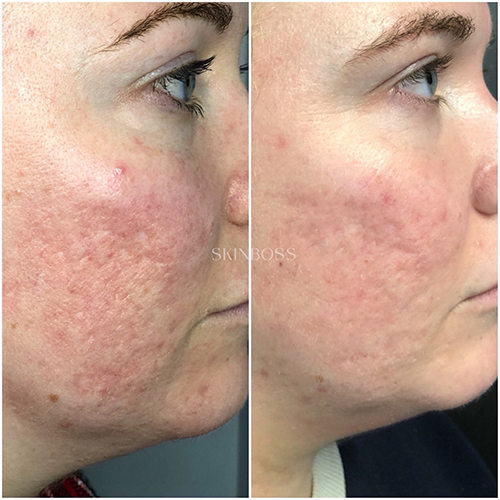 Skinboss - Acne Scaring & PIH - Before & After