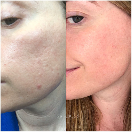 Skinboss - Acne Scaring & PIH - Before & After