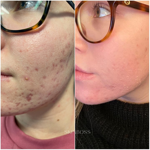 Skinboss - Acne Scaring & PIH - Before & After