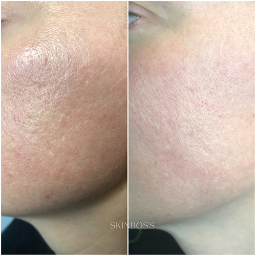 Skinboss - Acne Scaring & PIH - Before & After