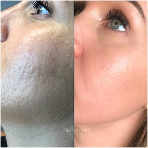 Skinboss - Acne Scaring & PIH - Before & After