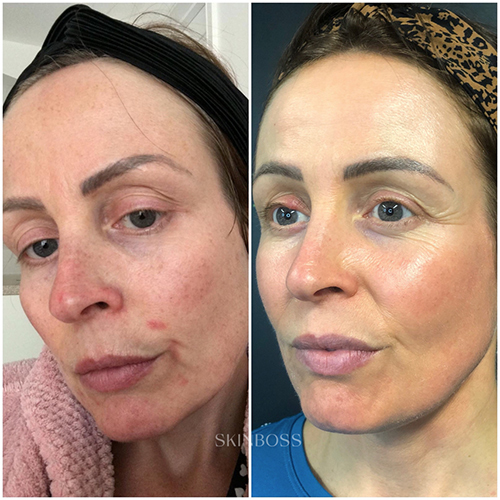 Skinboss - Ageing - Before & After