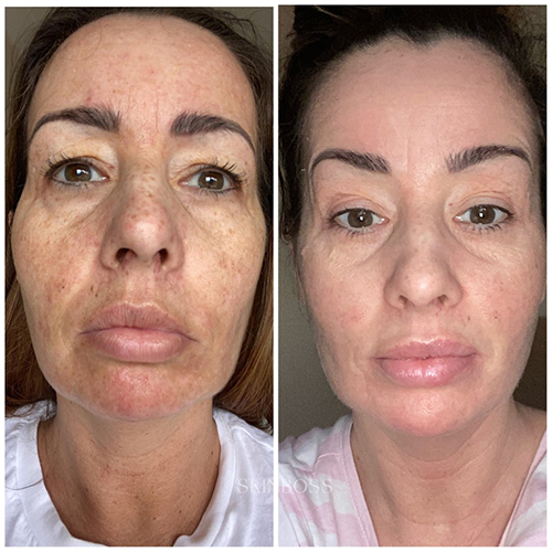 Skinboss - Ageing - Before & After