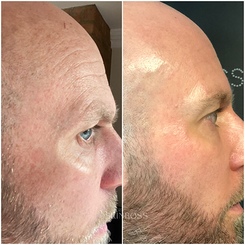 Skinboss - Ageing - Before & After