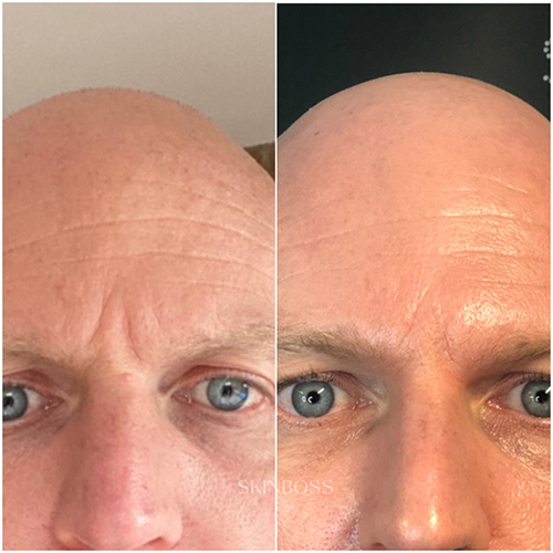 Skinboss - Ageing - Before & After