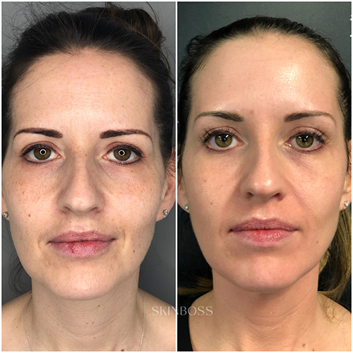 Skinboss - Ageing - Before & After