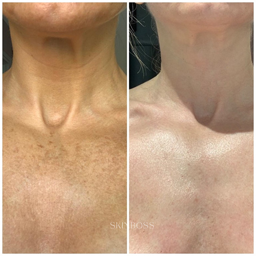 Skinboss - Ageing - Before & After